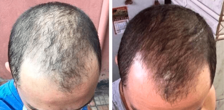 Antes e Depois queda de cabelo