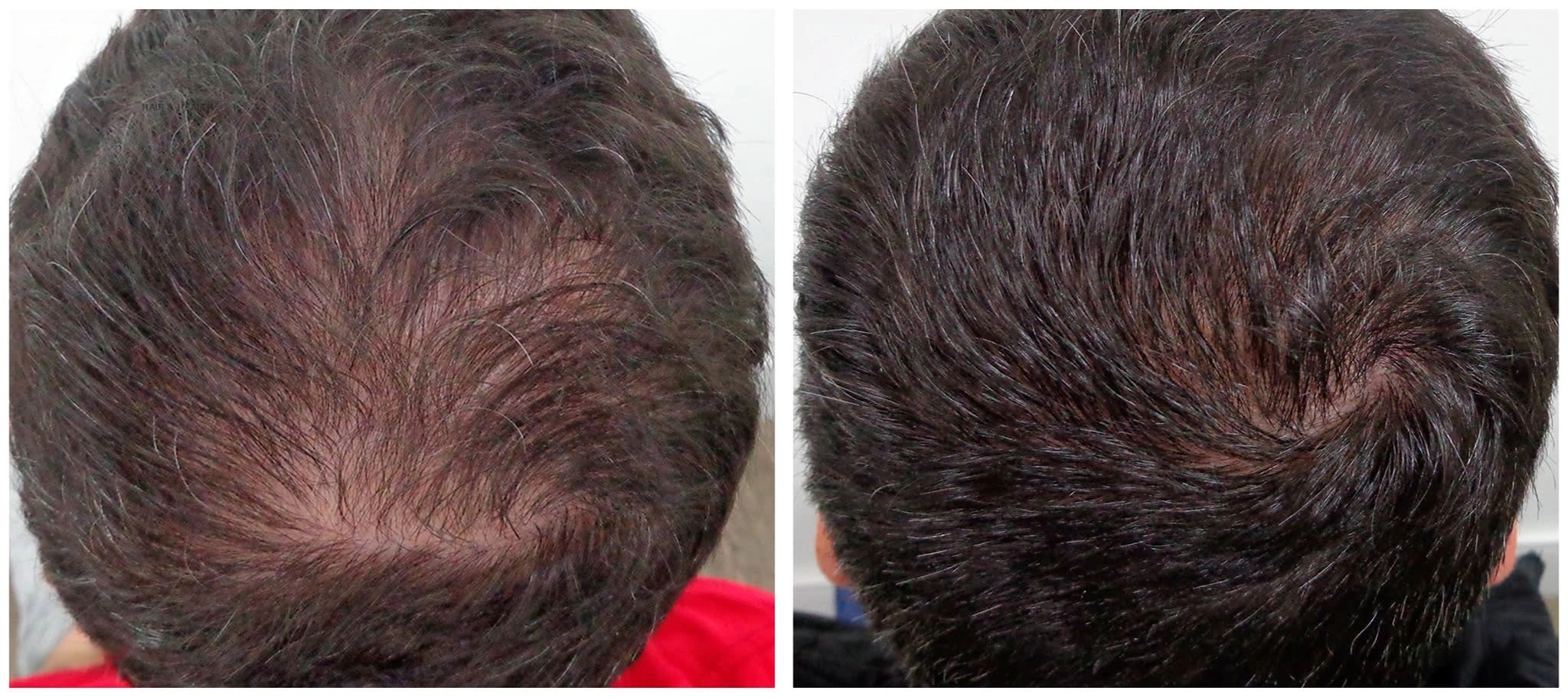 Antes e depois do uso de AloeCapilaris