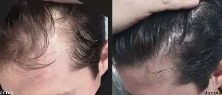 Antes e depois do uso de AloeCapilaris