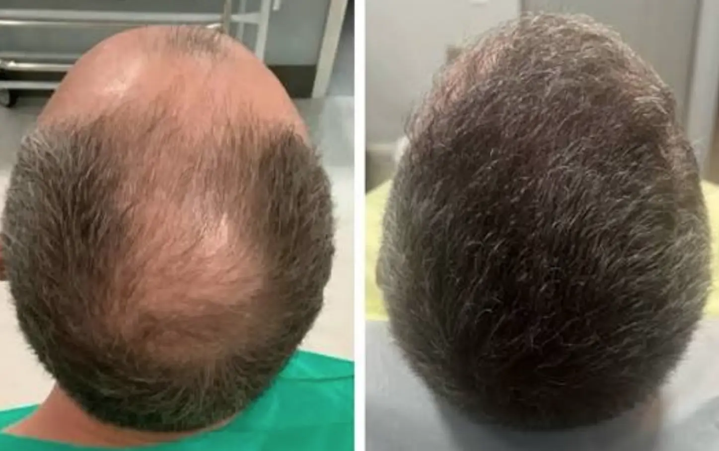 Antes e depois do uso de AloeCapilaris