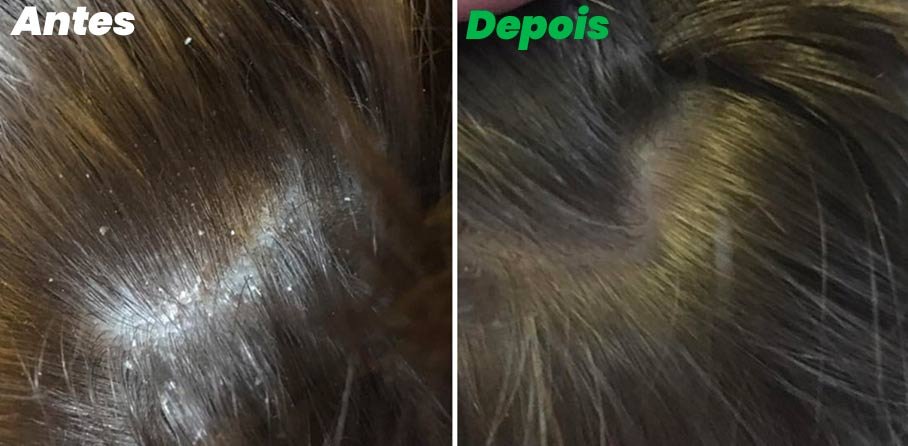 Antes e depois da caspa