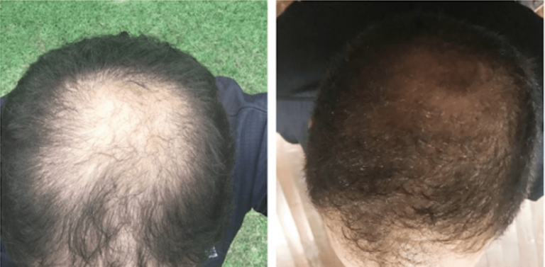 Antes e depois de Luiz