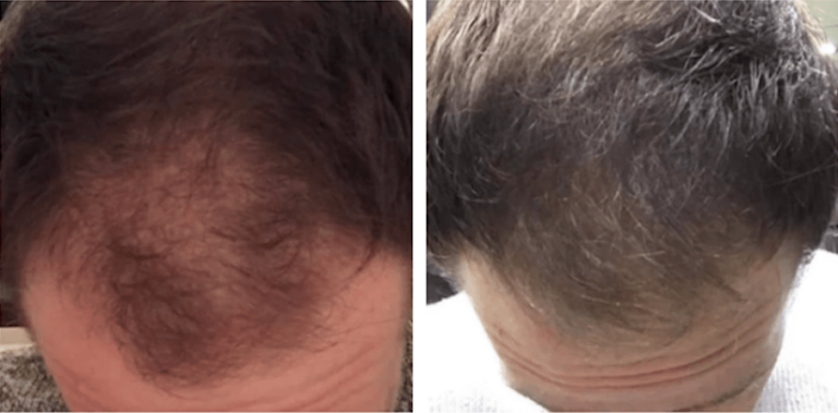 Antes e depois de Diego