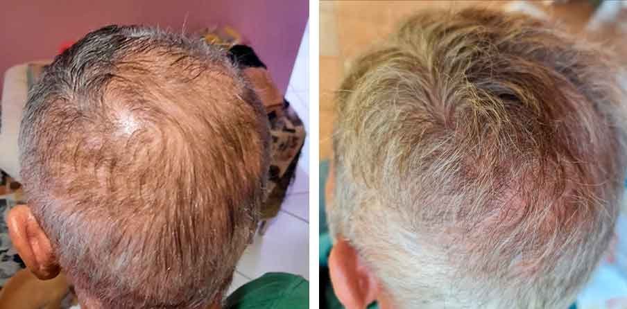 Antes e depois de Eliseu