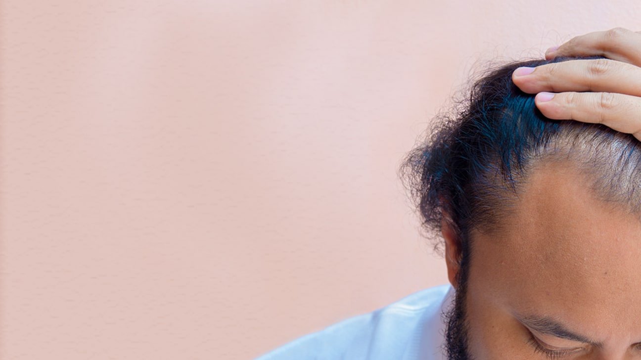 Homem avaliando as entradas do cabelo